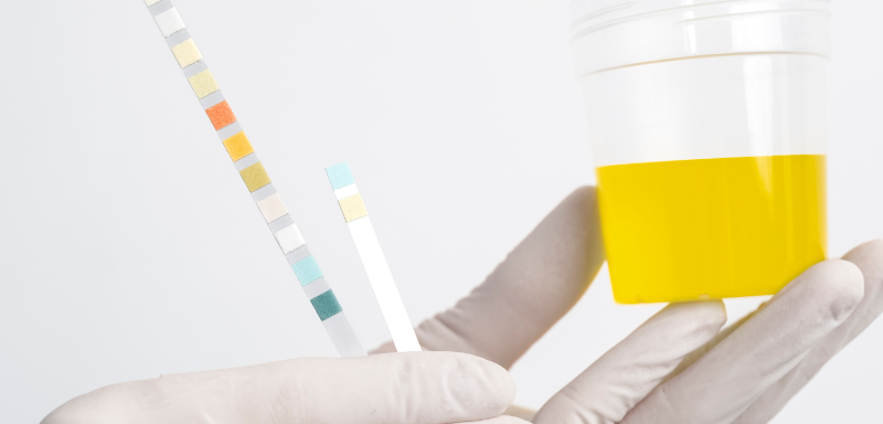 Urinalysis Analysis-Strip Test