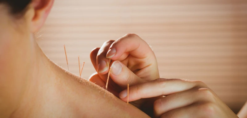 Acupuncture Treatment